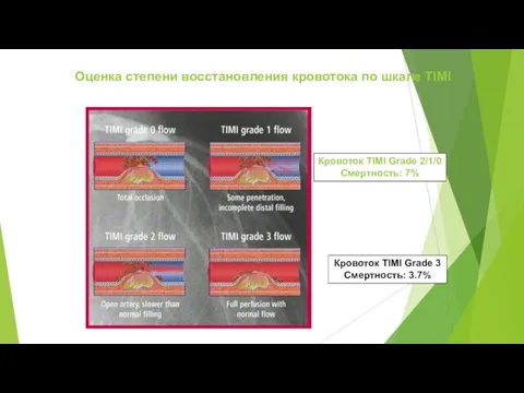 Оценка степени восстановления кровотока по шкале TIMI Кровоток TIMI Grade