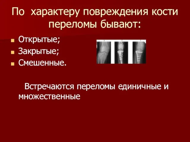 По характеру повреждения кости переломы бывают: Открытые; Закрытые; Смешенные. Встречаются переломы единичные и множественные