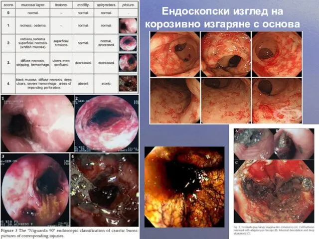 Ендоскопски изглед на корозивно изгаряне с основа