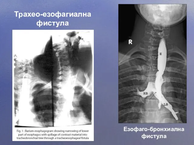 Езофаго-бронхиална фистула Трахео-езофагиална фистула