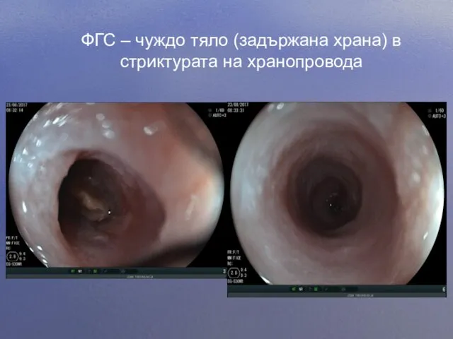 ФГС – чуждо тяло (задържана храна) в стриктурата на хранопровода