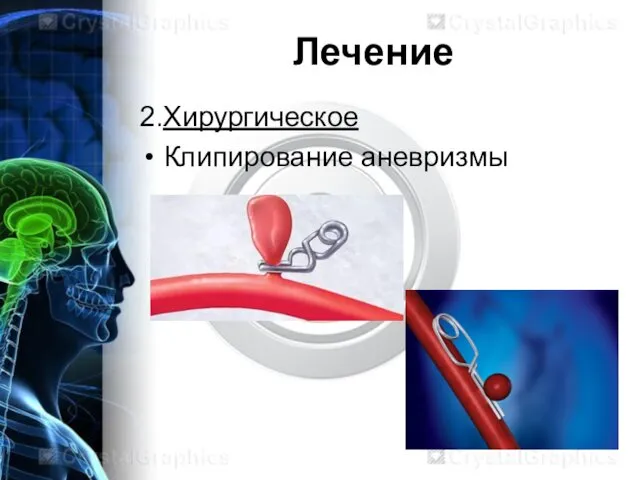 Лечение 2.Хирургическое Клипирование аневризмы