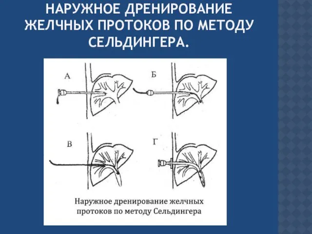 НАРУЖНОЕ ДРЕНИРОВАНИЕ ЖЕЛЧНЫХ ПРОТОКОВ ПО МЕТОДУ СЕЛЬДИНГЕРА.