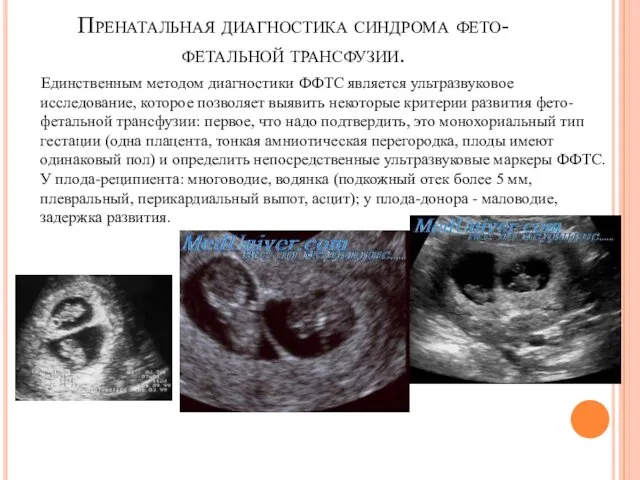 Пренатальная диагностика синдрома фето-фетальной трансфузии. Единственным методом диагностики ФФТС является