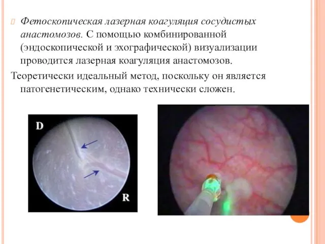 Фетоскопическая лазерная коагуляция сосудистых анастомозов. С помощью комбинированной (эндоскопической и