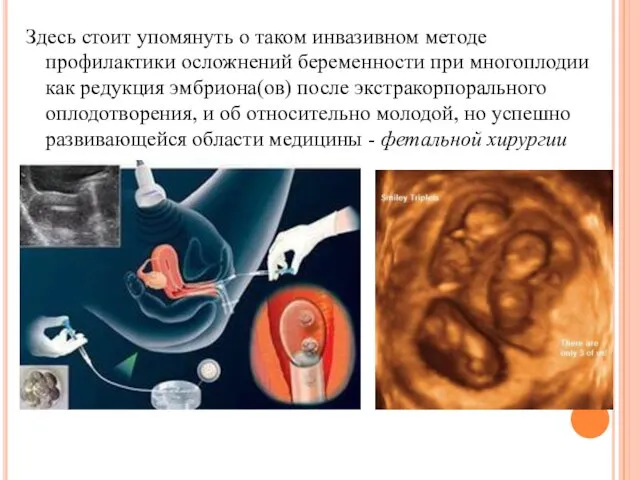 Здесь стоит упомянуть о таком инвазивном методе профилактики осложнений беременности