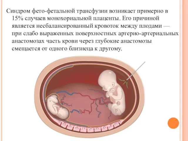Синдром фето-фетальной трансфузии возникает примерно в 15% случаев монохориальной плаценты.