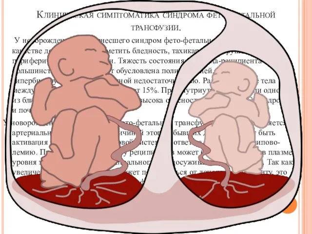 Клиническая симптоматика синдрома фето-фетальной трансфузии. У новорожденного, перенесшего синдром фето-фетальной