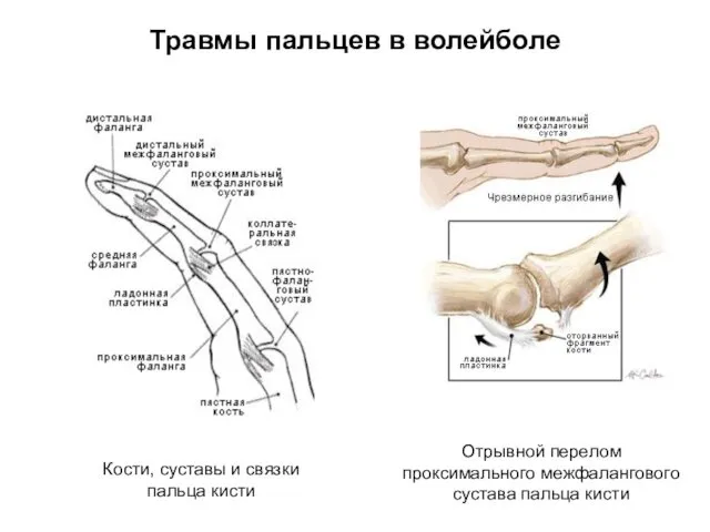 Травмы пальцев в волейболе Кости, суставы и связки пальца кисти Отрывной перелом проксимального