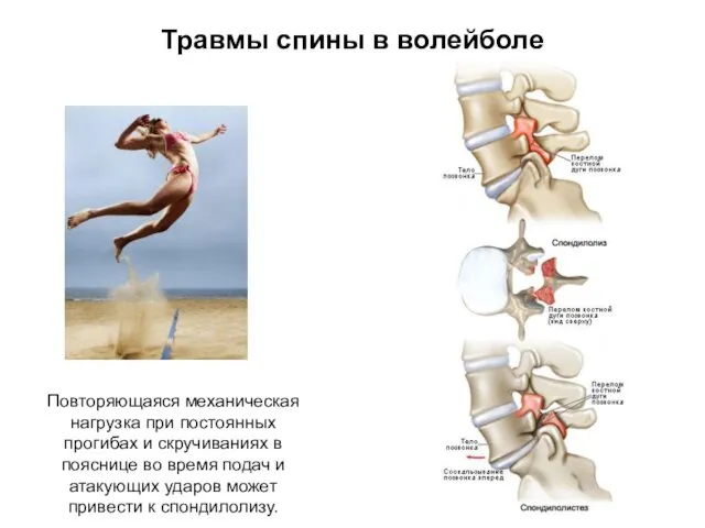 Травмы спины в волейболе Повторяющаяся механическая нагрузка при постоянных прогибах и скручиваниях в