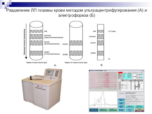 Разделение ЛП плазмы крови методом ультрацентрифугирования (А) и электрофореза (Б)