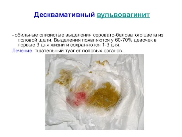 Десквамативный вульвовагинит – обильные слизистые выделения серовато-беловатого цвета из половой