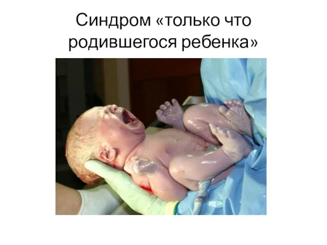 Синдром «только что родившегося ребенка»