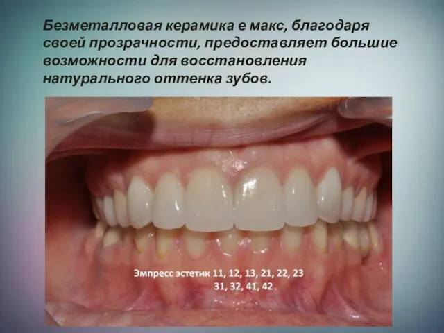 Безметалловая керамика е макс, благодаря своей прозрачности, предоставляет большие возможности для восстановления натурального оттенка зубов.