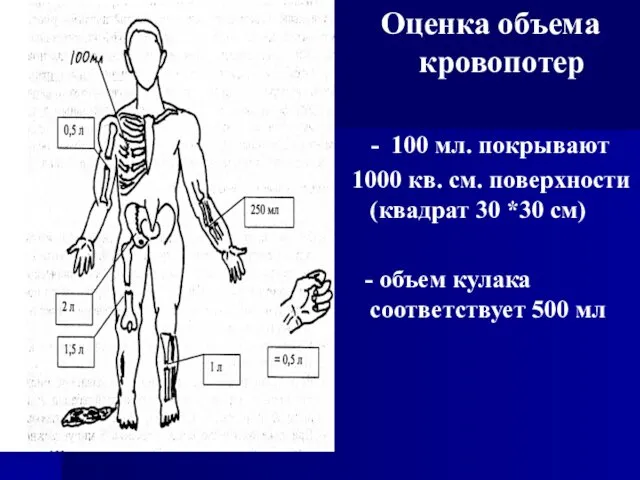 Оценка объема кровопотер - 100 мл. покрывают 1000 кв. см.