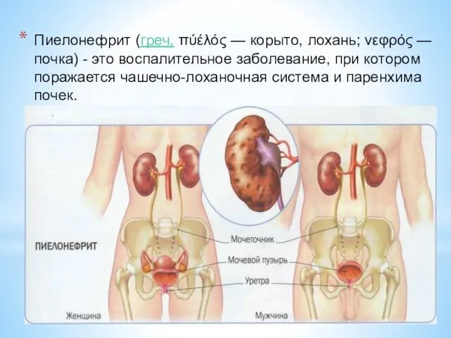 Пиелонефрит (греч. πύέλός — корыто, лохань; νεφρός — почка) -