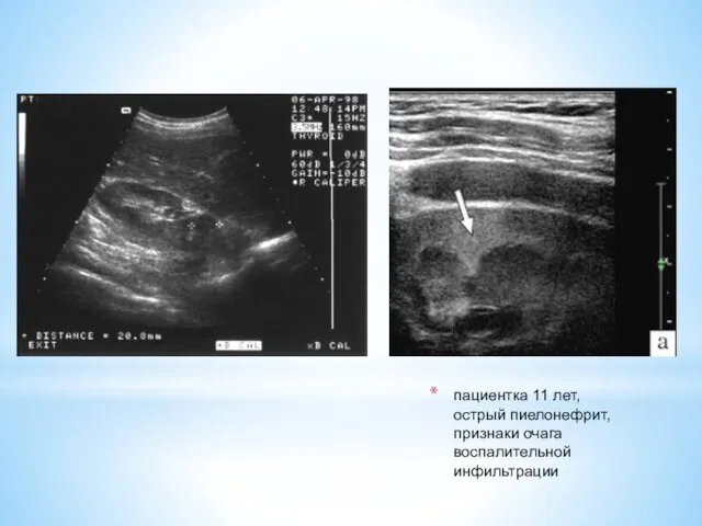 пациентка 11 лет, острый пиелонефрит, признаки очага воспалительной инфильтрации