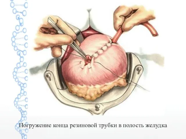 Погружение конца резиновой трубки в полость желудка