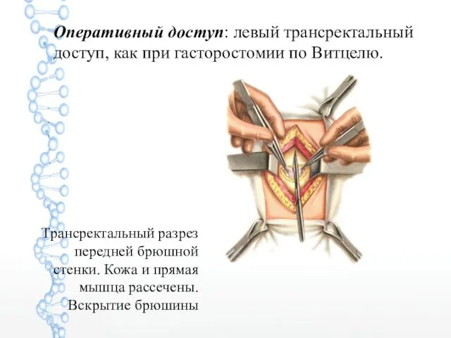 Трансректальный разрез передней брюшной стенки. Кожа и прямая мышца рассечены.