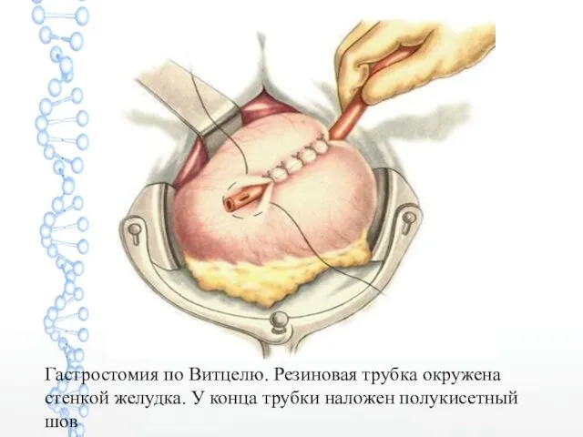 Гастростомия по Витцелю. Резиновая трубка окружена стенкой желудка. У конца трубки наложен полукисетный шов