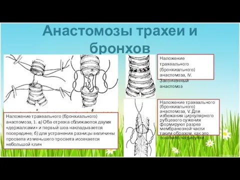 Анастомозы трахеи и бронхов Наложение трахеального (бронхиального) анастомоза, 1. а)