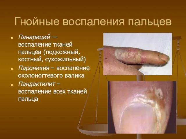 Гнойные воспаления пальцев Панариций — воспаление тканей пальцев (подкожный, костный,