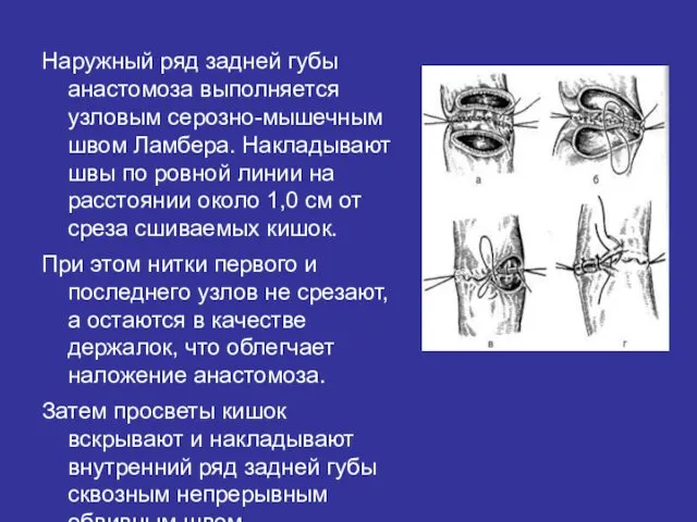 Наружный ряд задней губы анастомоза выполняется узловым серозно-мышечным швом Ламбера.