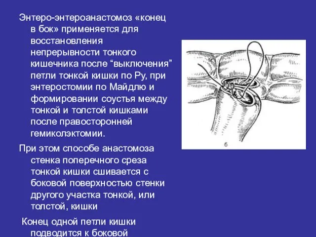 Энтеро-энтероанастомоз «конец в бок» применяется для восстановления непрерывности тонкого кишечника