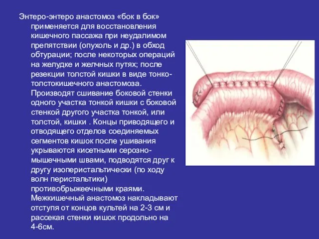 Энтеро-энтеро анастомоз «бок в бок» применяется для восстановления кишечного пассажа