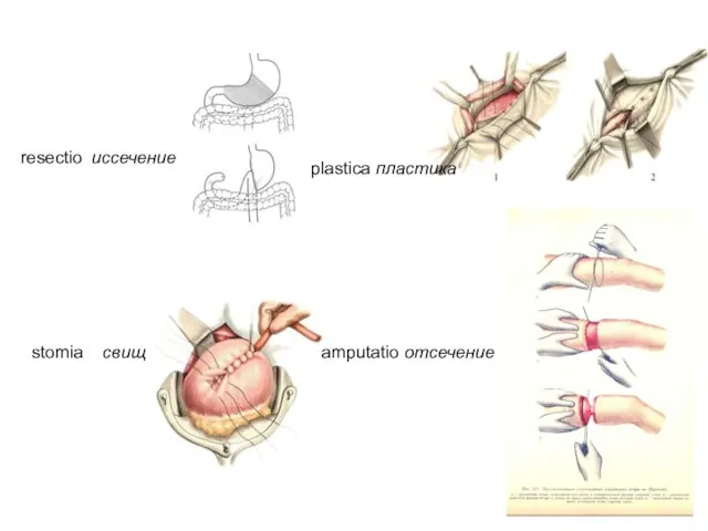 resectio иссечение stomia свищ plastica пластика amputatio отсечение