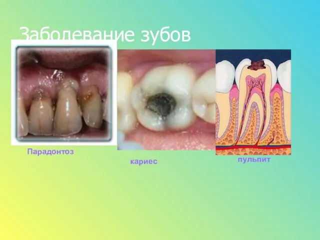 Заболевание зубов Парадонтоз кариес пульпит