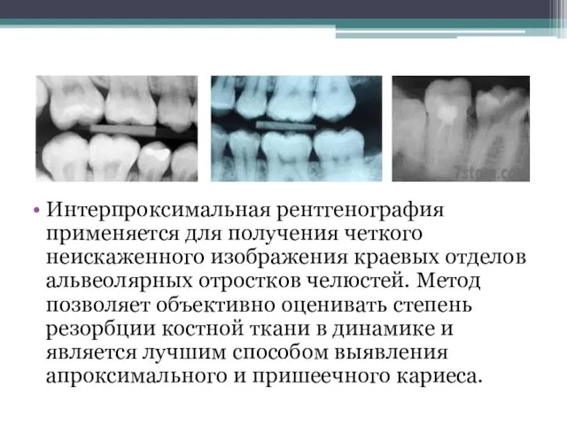 Интерпроксимальная рентгенография применяется для получения четкого неискаженного изображения краевых отделов