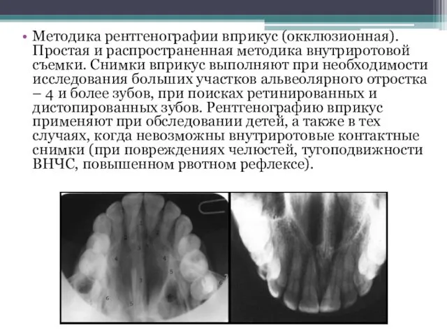 Методика рентгенографии вприкус (окклюзионная). Простая и распространенная методика внутриротовой съемки.