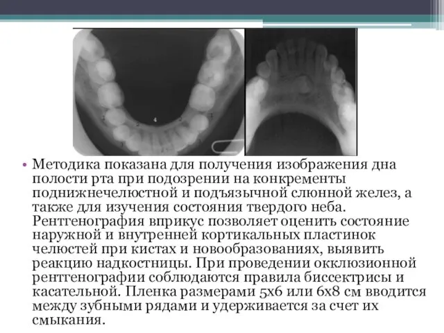 Методика показана для получения изображения дна полости рта при подозрении