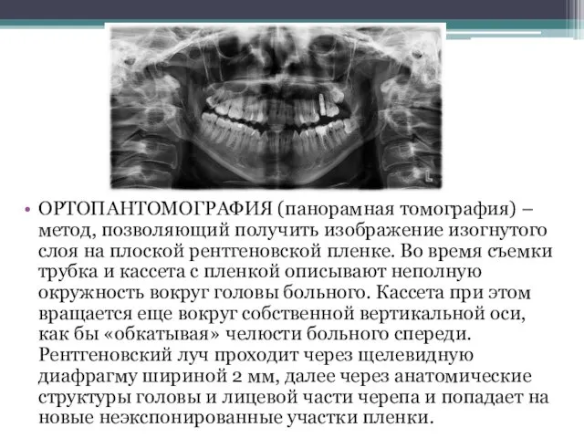 ОРТОПАНТОМОГРАФИЯ (панорамная томография) – метод, позволяющий получить изображение изогнутого слоя