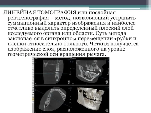 ЛИНЕЙНАЯ ТОМОГРАФИЯ или послойная рентгенография – метод, позволяющий устранить суммационный