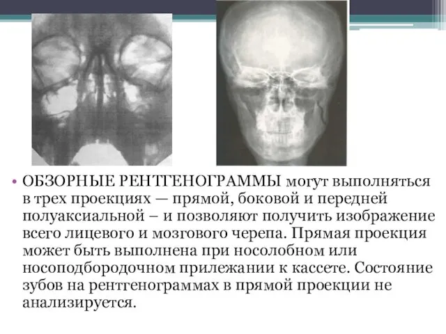 ОБЗОРНЫЕ РЕНТГЕНОГРАММЫ могут выполняться в трех проекциях — прямой, боковой