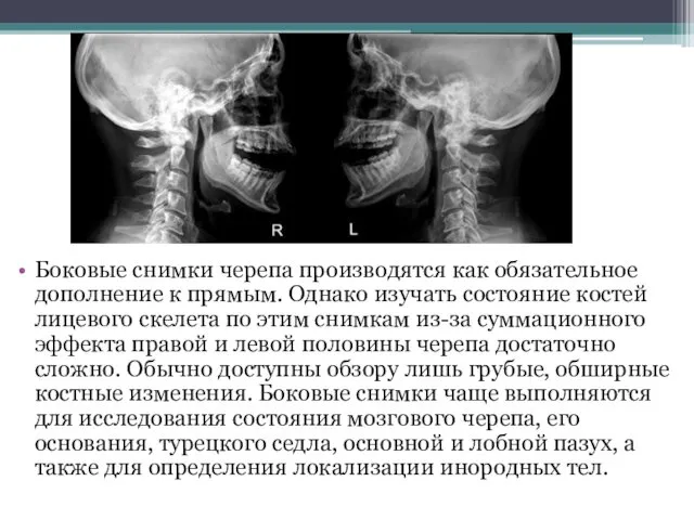 Боковые снимки черепа производятся как обязательное дополнение к прямым. Однако