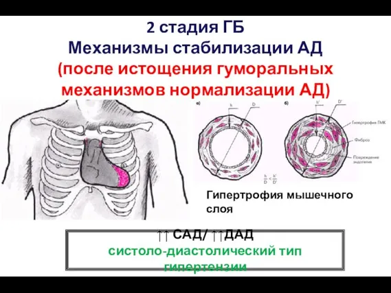 2 стадия ГБ Механизмы стабилизации АД (после истощения гуморальных механизмов