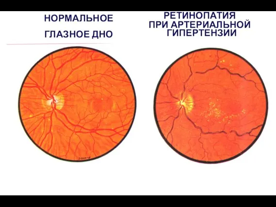 НОРМАЛЬНОЕ ГЛАЗНОЕ ДНО РЕТИНОПАТИЯ ПРИ АРТЕРИАЛЬНОЙ ГИПЕРТЕНЗИИ