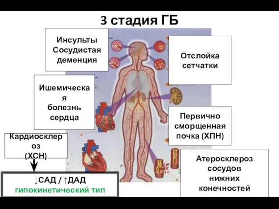 3 стадия ГБ Отслойка сетчатки Первично сморщенная почка (ХПН) Атеросклероз