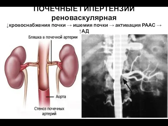 ПОЧЕЧНЫЕ ГИПЕРТЕНЗИИ реноваскулярная ↓кровоснабжения почки → ишемия почки → активация РААС → ↑АД