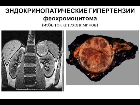 ЭНДОКРИНОПАТИЧЕСКИЕ ГИПЕРТЕНЗИИ феохромоцитома (избыток катехоламинов)