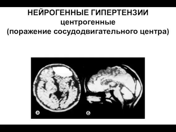 НЕЙРОГЕННЫЕ ГИПЕРТЕНЗИИ центрогенные (поражение сосудодвигательного центра)