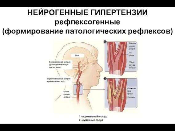 НЕЙРОГЕННЫЕ ГИПЕРТЕНЗИИ рефлексогенные (формирование патологических рефлексов)