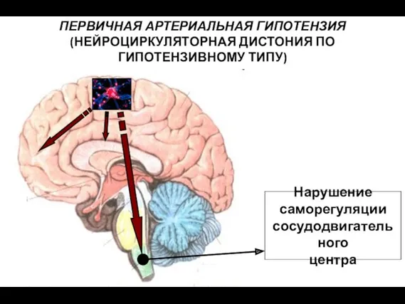 Нарушение саморегуляции сосудодвигательного центра ПЕРВИЧНАЯ АРТЕРИАЛЬНАЯ ГИПОТЕНЗИЯ (НЕЙРОЦИРКУЛЯТОРНАЯ ДИСТОНИЯ ПО ГИПОТЕНЗИВНОМУ ТИПУ)