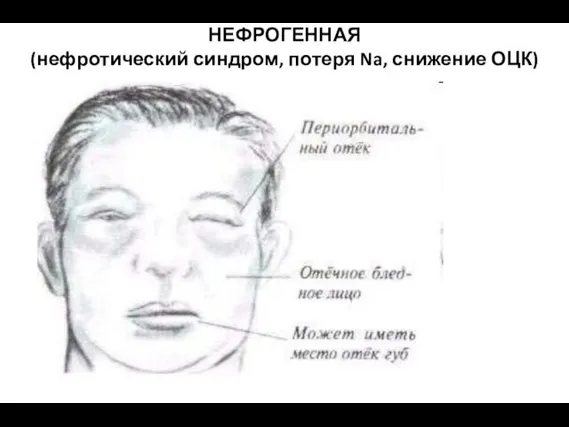 НЕФРОГЕННАЯ (нефротический синдром, потеря Na, снижение ОЦК)