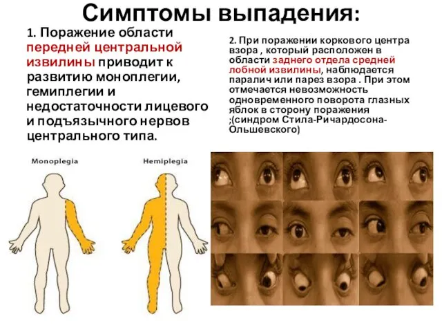 Симптомы выпадения: 1. Поражение области передней центральной извилины приводит к