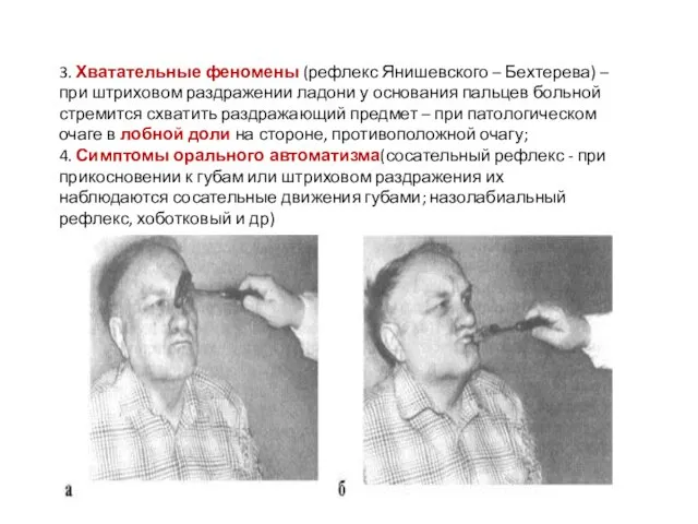 3. Хватательные феномены (рефлекс Янишевского – Бехтерева) – при штриховом