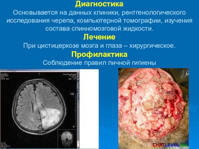 Диагностика Основывается на данных клиники, рентгенологического исследования черепа, компьютерной томографии,